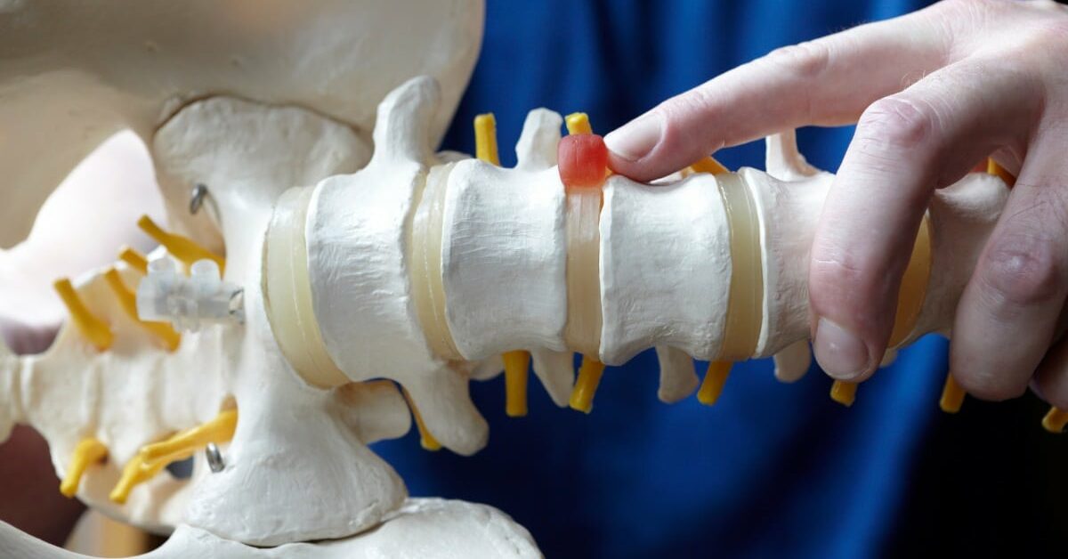 Du betrachtest gerade Ist Akupunktur bei Bandscheibenvorfall sinnvoll?