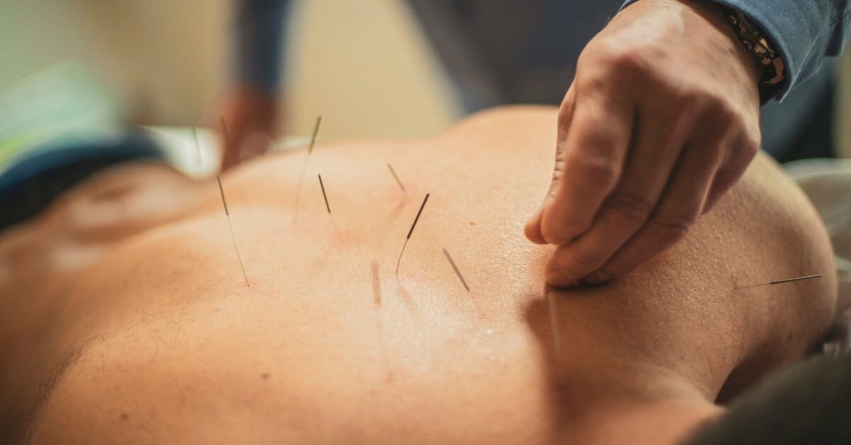 You are currently viewing Acupuncture for MS patients: Complementary support