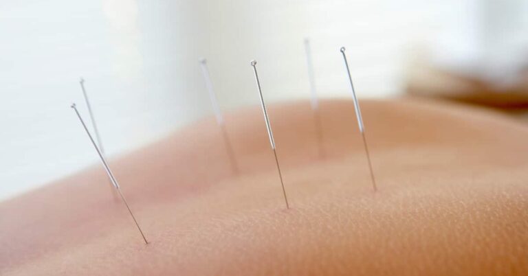 Mehr über den Artikel erfahren Wie viele Sitzungen Akupunktur sind erforderlich?