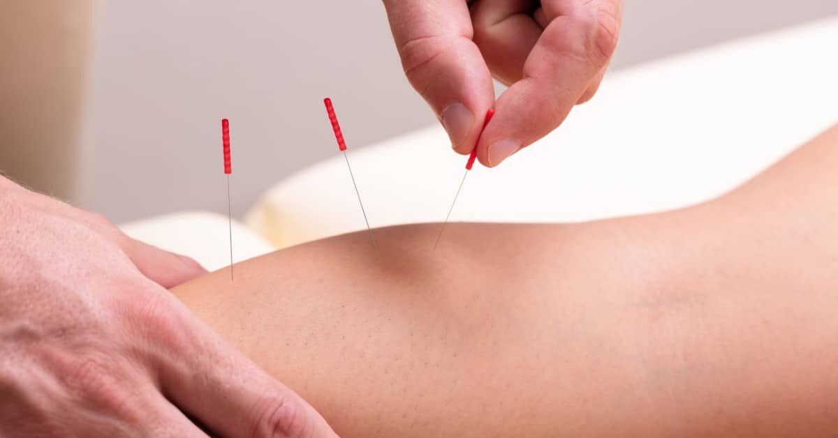 Du betrachtest gerade Knieschmerzen lindern mit Akupunktur: Was Sie wissen müssen